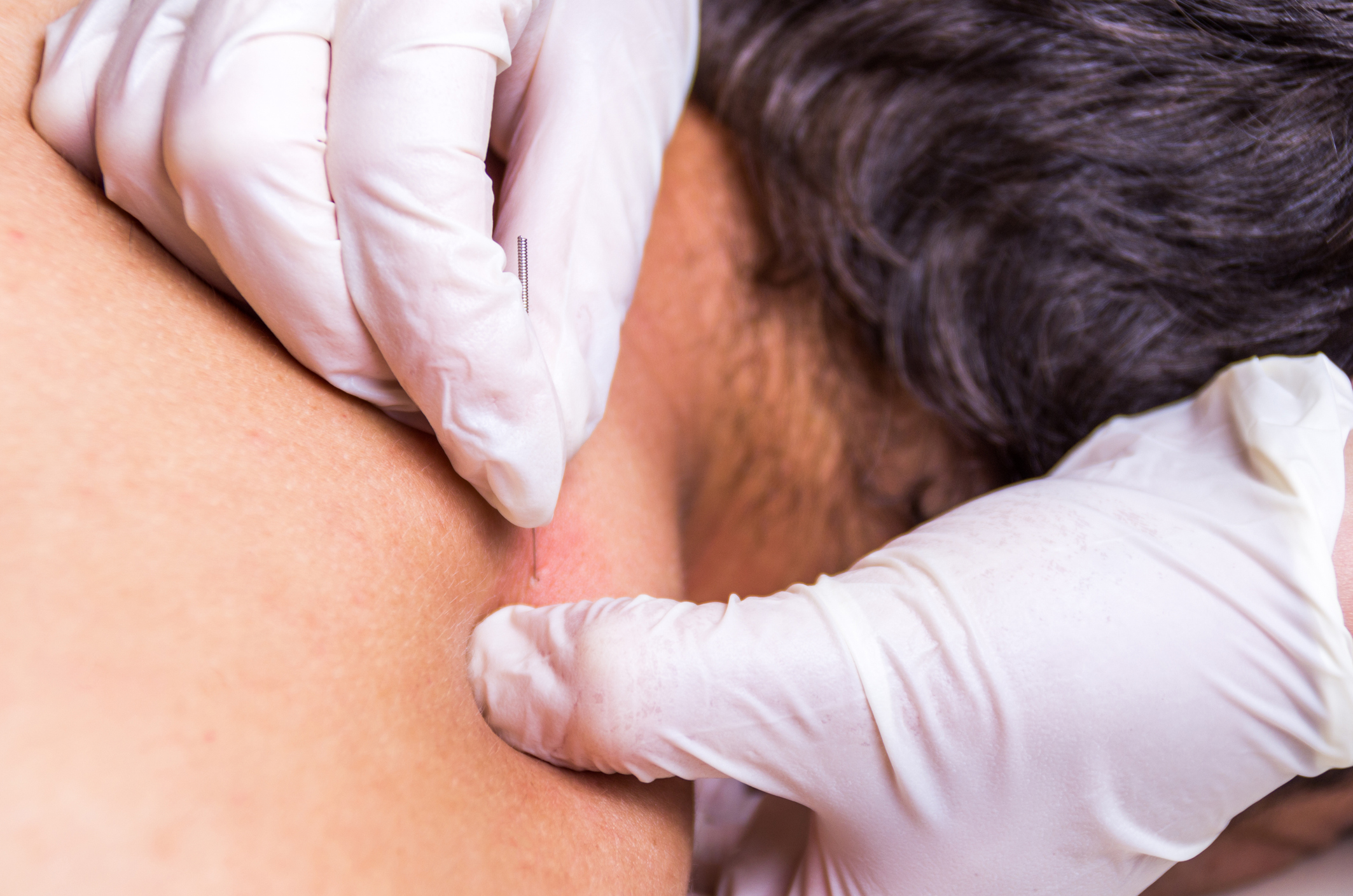Dry Needling
